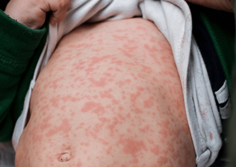 ALERTA SANITARIA EN MÉXICO: BROTE DE SARAMPIÓN DEJA CERCA DE 30 MUERTES