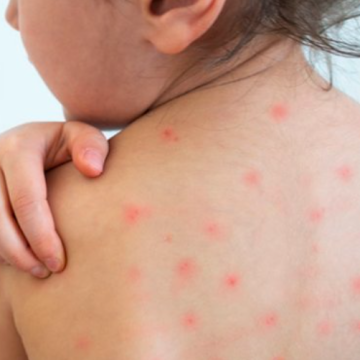 MINSAL CONFIRMA 11 CASOS DE SARAMPIÓN Y ACTIVA CERCO EPIDEMIOLÓGICO EN EL SALVADOR