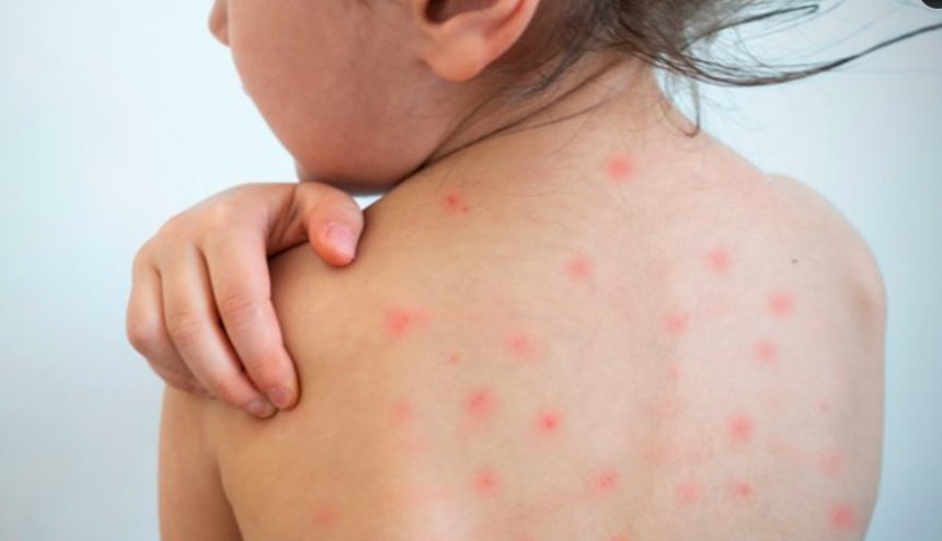 MINSAL CONFIRMA 11 CASOS DE SARAMPIÓN Y ACTIVA CERCO EPIDEMIOLÓGICO EN EL SALVADOR