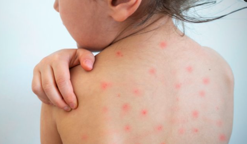 MINSAL CONFIRMA 11 CASOS DE SARAMPIÓN Y ACTIVA CERCO EPIDEMIOLÓGICO EN EL SALVADOR